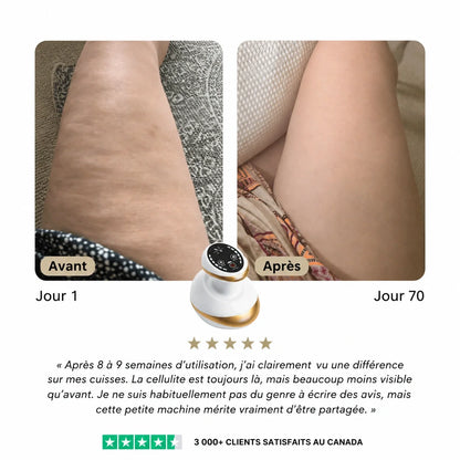 Osmotia™ | Appareil de massage anti-cellulite